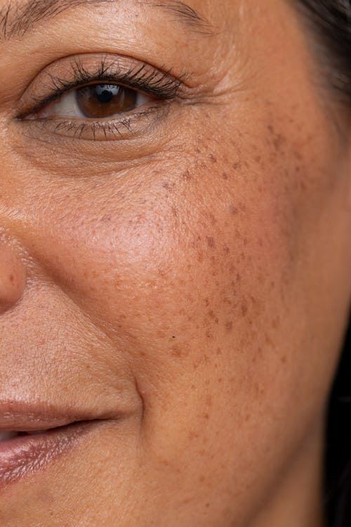 Pigmentation & Tone