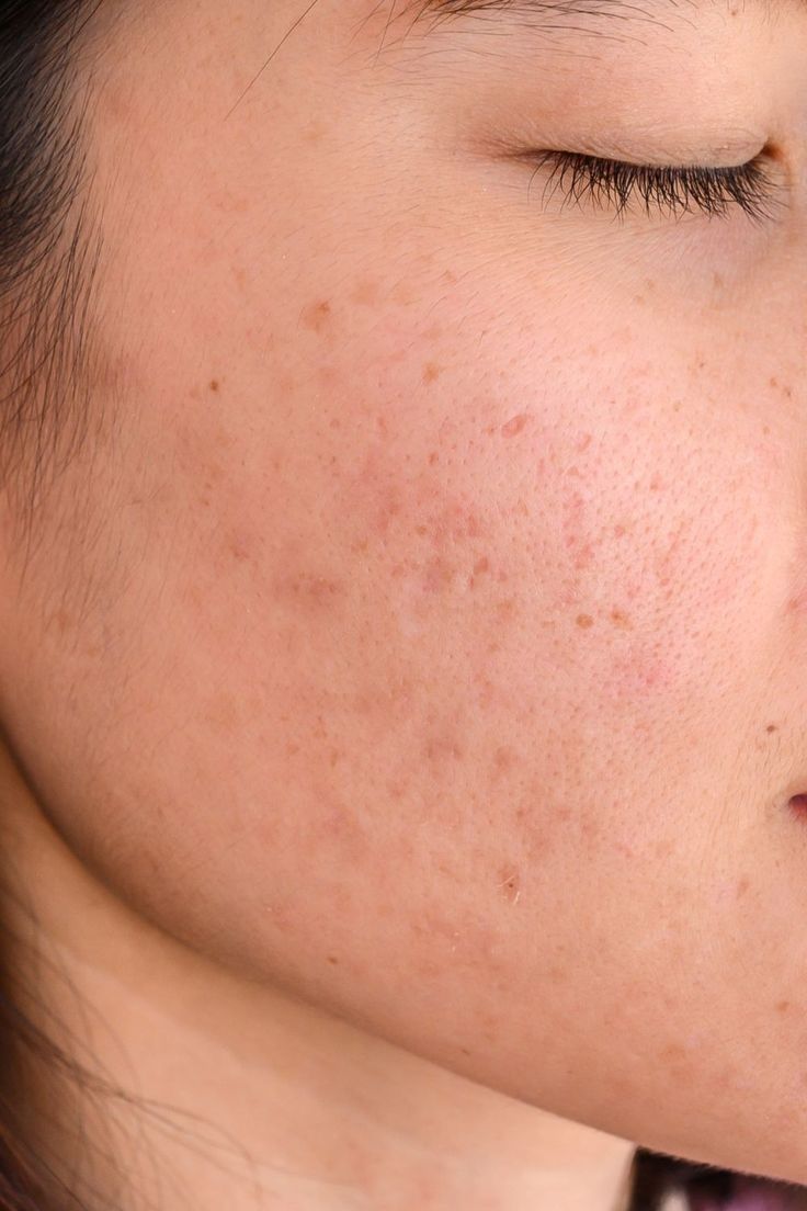 Acne Scarring